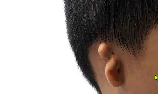 Mengenal Mikrotia Kelainan Bentuk Daun Telinga