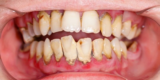 Cara Menghilangkan Plak pada Gigi