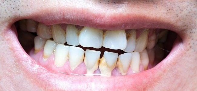 Kenali Penyakit yang Disebabkan Plak Gigi
